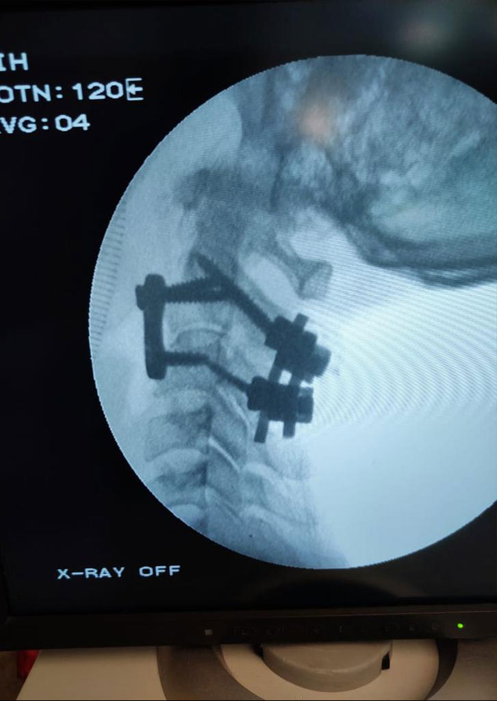 cervical spine fixation surgery in surat gujarat