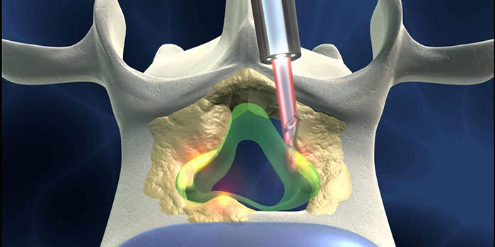 endoscopic spine surgery in surat, gujarat - dr sunny shethna