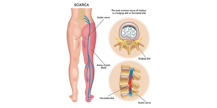 sciatica - causes and treatment in surat, gujarat