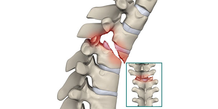 spinal fracture treatment in surat, gujarat