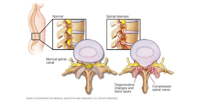 spinal stenosis - symptoms & treatment in surat, gujarat