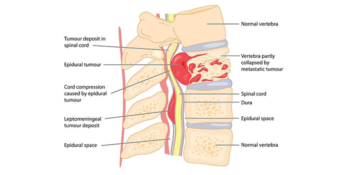 spinal tumor - diagnosis and treatment in surat, gujarat