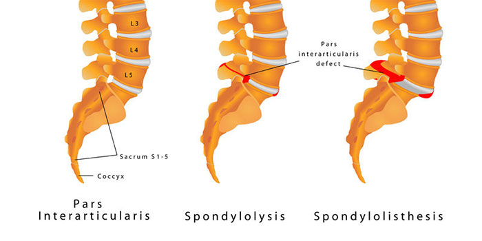 spondylolisthesis - causes and treatment in surat, gujarat