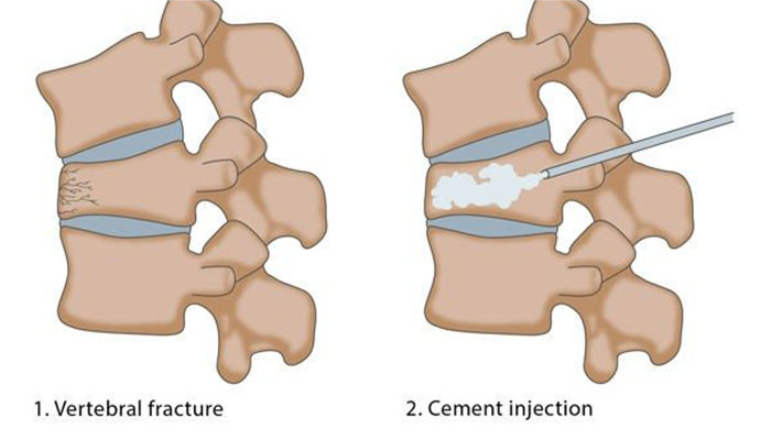 vertebroplasty in surat, gujarat - dr sunny shethna